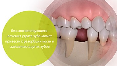 протезирование на имплантатах для восстановления отсутствующих зубов - фото - 1